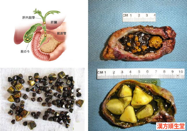 胆石 は 酢 で 溶ける